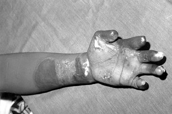 Fig. 1Epileptic with severely burned hand and partial amputation of digits.