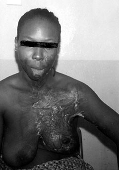 Fig. 2bSame patient after release of mentosternal contracture.&nbsp;&nbsp;&nbsp;