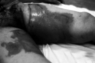 Fig. 1aFresh burn injury-before collagen application.