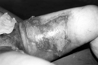 Fig. 1bThree days after collagen application.