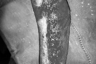 Fig. 2aTwo weeks after burn injury - classic treatment.
