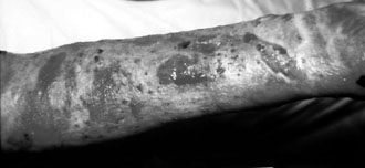 Fig. 2cTen days after collagen application.