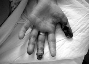 Fig. 1Necrosis of 1st, 3rd, and 4th fingers three weeks after electrical burns (volar side).