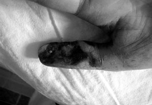 Fig. 2Necrosis of thumb after electrical burns (volar side).