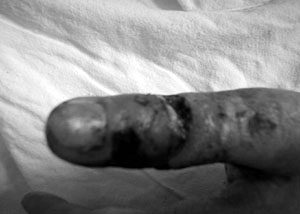 Fig. 3Necrosis of thumb after electrical burns (dorsal side).