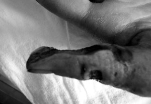 Fig. 4Necrosis of thumb - distal part of phalanx after electrical burns.