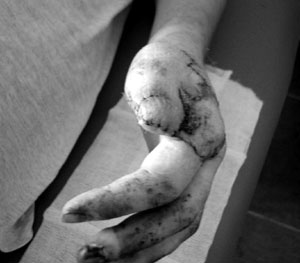 Fig. 5Thumb reconstruction with neurovascular cross-finger flap after amputation of two-thirds of phalanges (left hand).