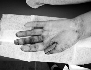 Fig. 6Thumb reconstruction with neurovascular cross-finger flap (volar side).