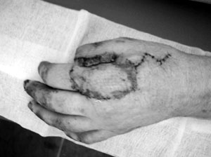 Fig. 7Thumb reconstruction with neurovascular cross finger flap, full-thickness graft of index finger, and zigzag incision for radial sensation (dorsal side).