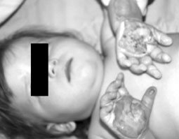 Fig. 3.1aPatient N.I.V., 2 years old, immediately after contact burn.