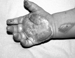 Fig. 3.1bPatient N.I.V., 2 years old, immediately after contact burn.