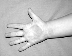 Fig. 3.2Same patient one year after accident.&nbsp;
