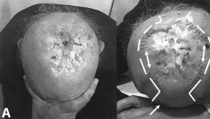 Fig. 1Extensive scalp scarring with multifocal ulcerations. 1b - Two tissue expanders inserted in the parietal areas. Dissected pockets indicated by broken lines. Double-headed arrows indicate bridge of skin left intact in the middle of proposed incision for expander insertion in order to prevent scar spreading during expansion. Single-headed arrow indicates scarring at entry wound over the forehead.