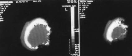 Fig. 2CT scan demonstration of extensive bony erosion.