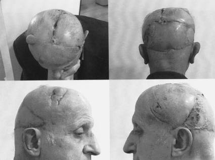 Fig. 3Reconstruction result at two weeks with bilateral anteriorly based parieto-occipital scalp flaps. Donor site covered with STSG.