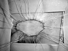 Fig. 3Intra-operative view. Full-thickness skin graft.