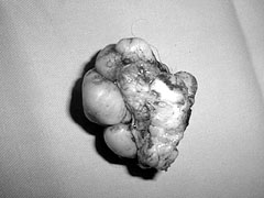 Fig. 4Upside down view of excised keloid.&nbsp;