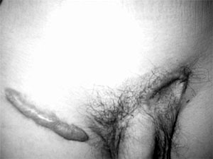 Fig. 6Keloid recurrence one year post-op.