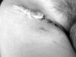 Fig. 7After removal of suture, 2 weeks post-op and immediate treatment as described previously.