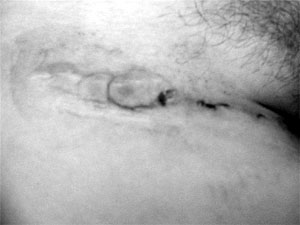 Fig. 8Four weeks post-op. Surgical partial excision (according to our chart).