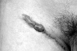 Fig. 9Seven weeks post-surgical excision and other treatments as described.