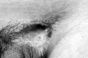 Fig. 10Showing use of silicon gel and pressure therapy.