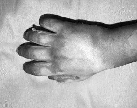 Fig. 4Patient N.G.H., 8 years old, immediately after accident.