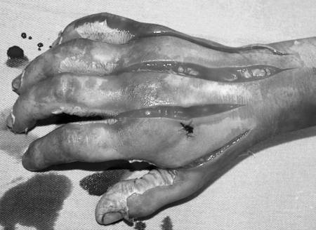 Fig. 5Necrotomy performed during admission.