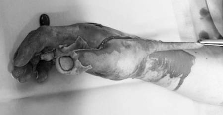 Fig. 6Early surgical excision day 2 post-burn.