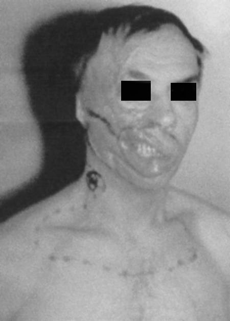 Fig. 1aPre-operative view, borders marked of scar excision and flap mobilization.