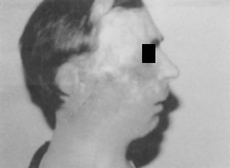 Fig. 1bResult of reconstruction by neck flap.
