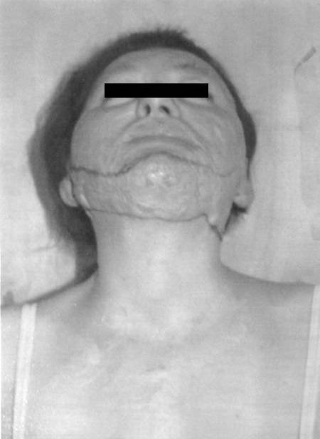 Fig. 2aPre-operative basal view.