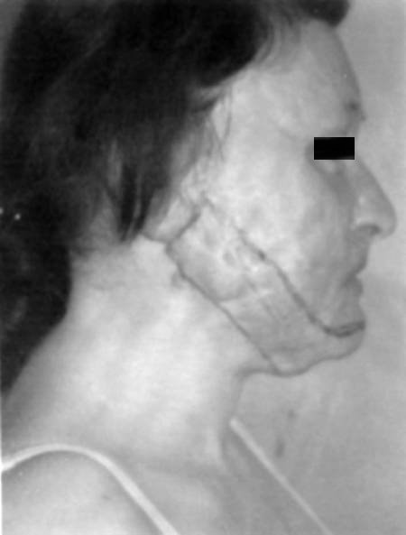 Fig. 2bPre-operative right profile view.