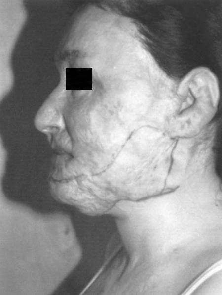 Fig. 2cPre-operative left profile view.