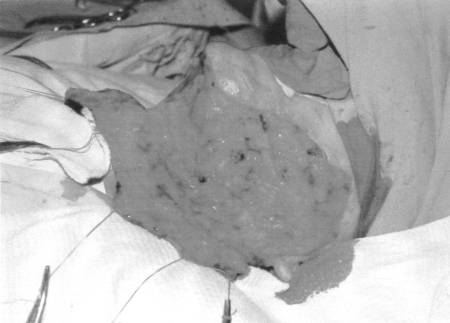 Fig. 2dMobilized fat-cutaneous neck flap.