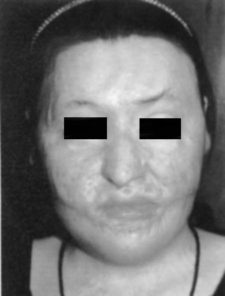 Fig. 2ePost-operative frontal view.