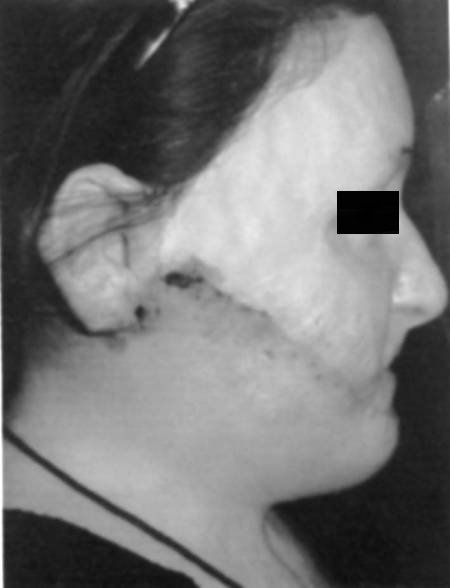 Fig. 2fPost-operative right profile view.