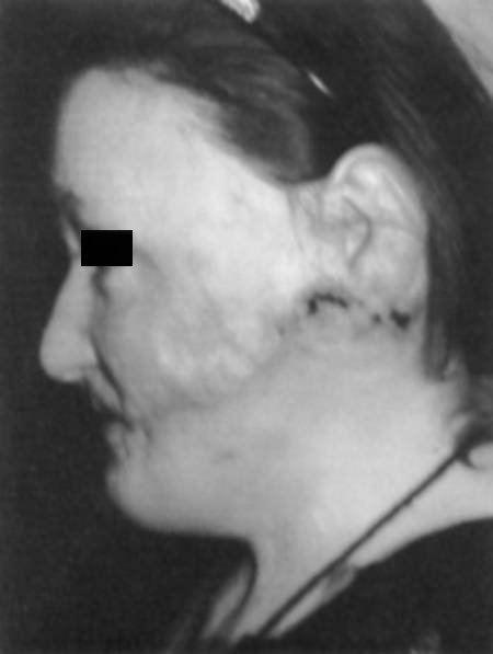 Fig. 2gPost-operative left profile view.