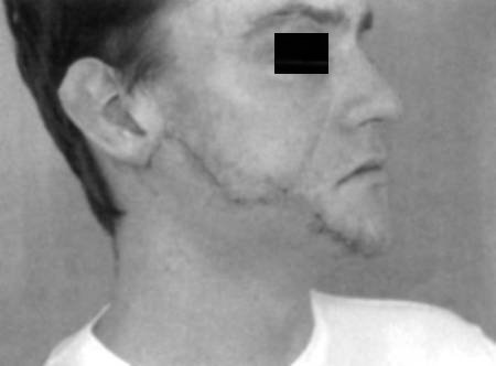 Fig. 3bPre-operative right profile view.
