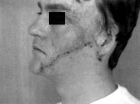 Fig. 3cPre-operative left profile view.