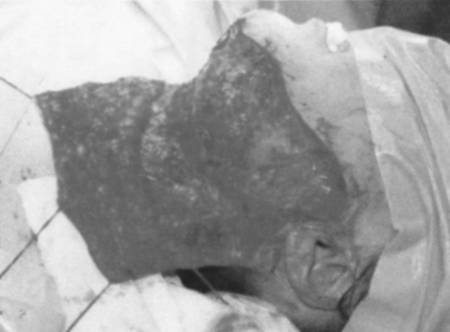 Fig. 3dMobilized neck flap.