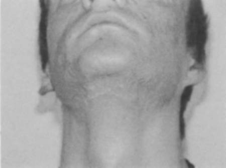 Fig. 3ePost-operative frontal view.