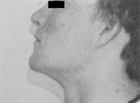 Fig. 3gPost-operative left profile view.