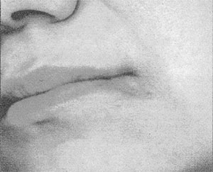 Fig. 1Comma-like burn resembling an orthodontic pliers jaw-like pattern.