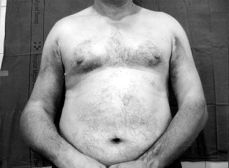 Fig. 1Clinical appearance of patient with bilateral shoulder fractures, day 5.