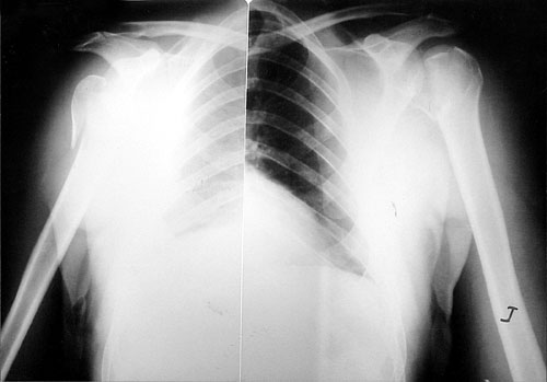 Fig. 2X-ray diagnosis. Right shoulder: dislocation-fracture of humerus. Left shoulder: humeral fracture with displacement by segments.