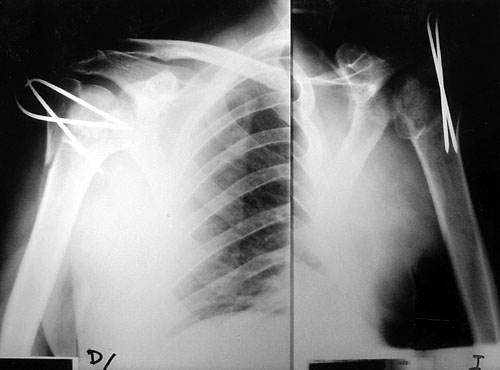 impacted shoulder fracture impacted shoulder fracture