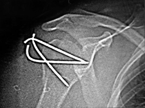 Fig. 4RMN image post-operative (in detail) of right shoulder.