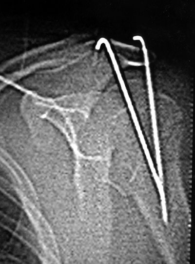Fig. 5RMN image post-operative (in detail) of left shoulder.