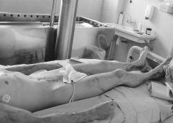Fig. 3Scattered burns in abdomen, thighs, and distally lower limbs.